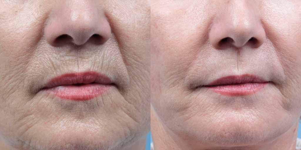 Omenaviinietikka: miten sitä käytetään ryppyjen luonnolliseen tasoittamiseen