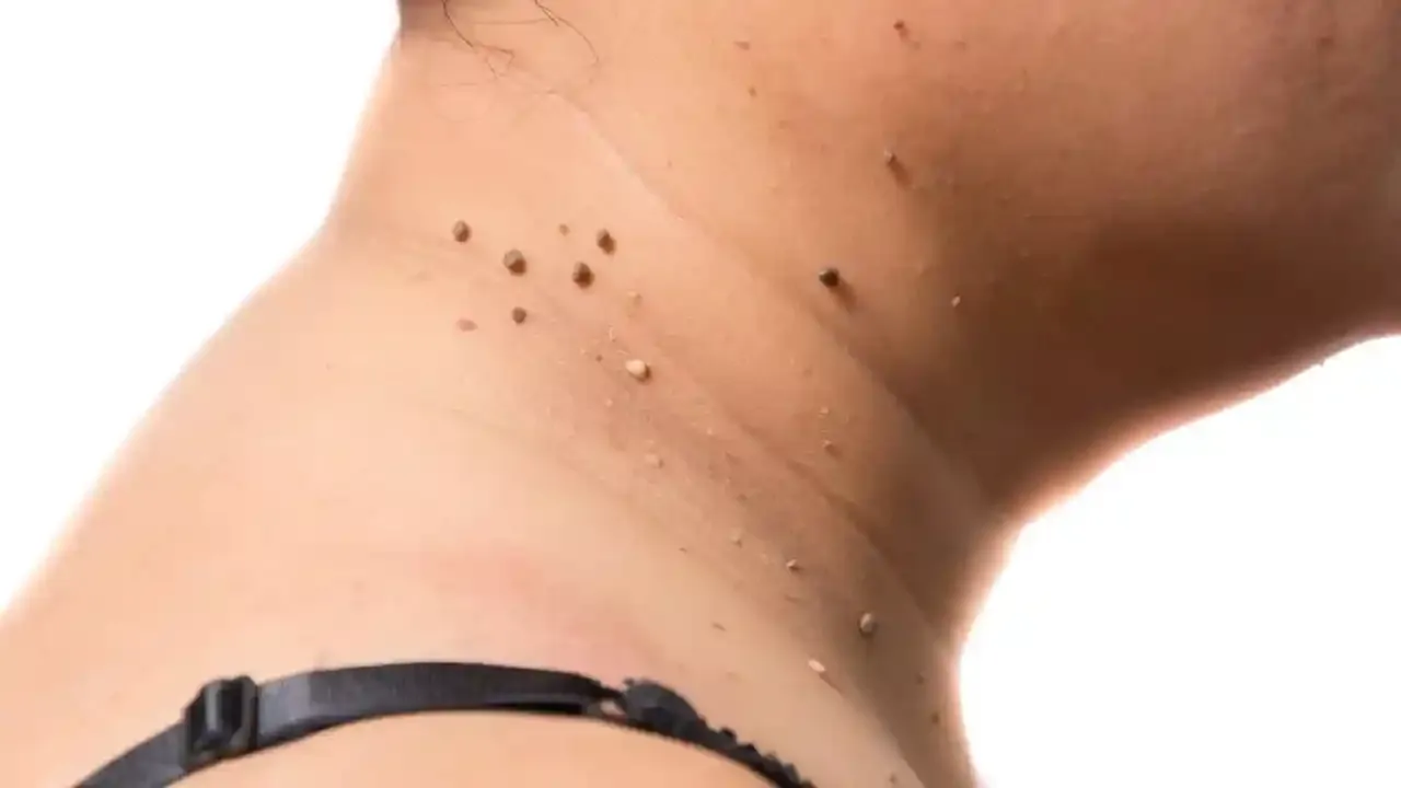 Onko sinulla fibromyoma kaulassa? Tutkijat ovat havainneet säännönmukaisuuden.