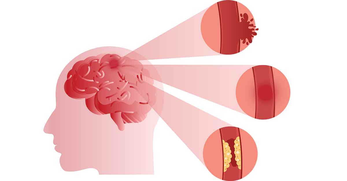 Onko hiustenpesun jälkeen riski saada aivohalvaus?