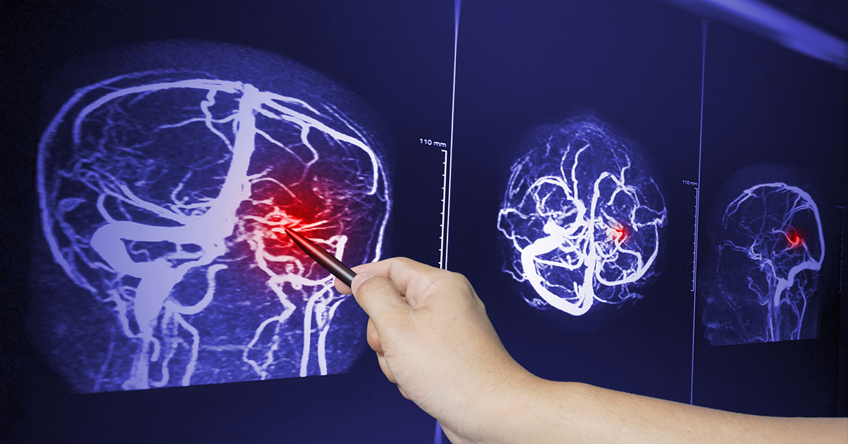 Keinotekoiset kohteet lääkkeiden toimittamiseksi aivoihin?