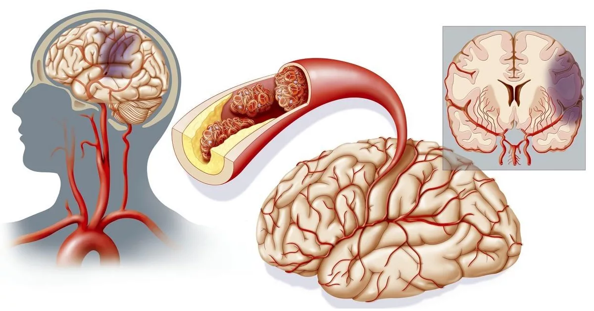 Onko hiustenpesun jälkeen riski saada aivohalvaus?