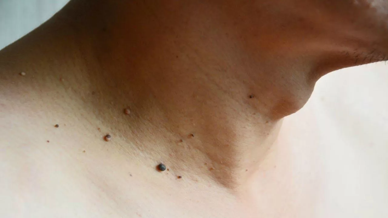 Onko sinulla fibromyoma kaulassa? Tutkijat ovat havainneet säännönmukaisuuden.