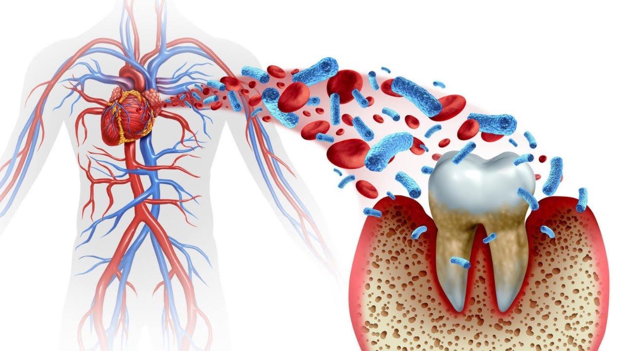 Lisää sydänkohtauksen riskiä