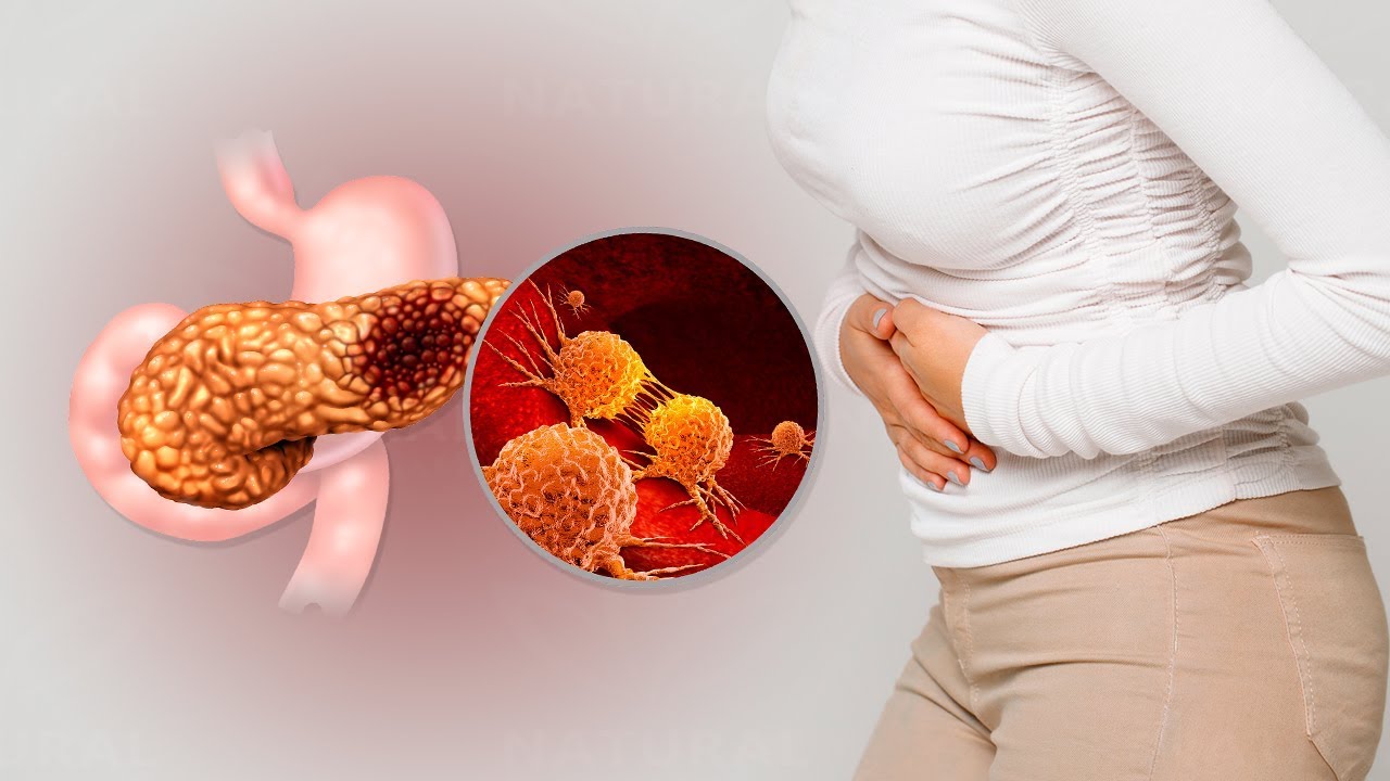 Diagnoosi – Haimasyöpä: Haimasyövän varoitusmerkit, jotka sinun tulisi tuntea