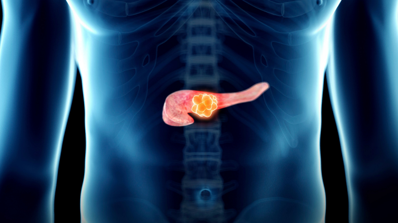 Diagnoosi – Haimasyöpä: Haimasyövän varoitusmerkit, jotka sinun tulisi tuntea