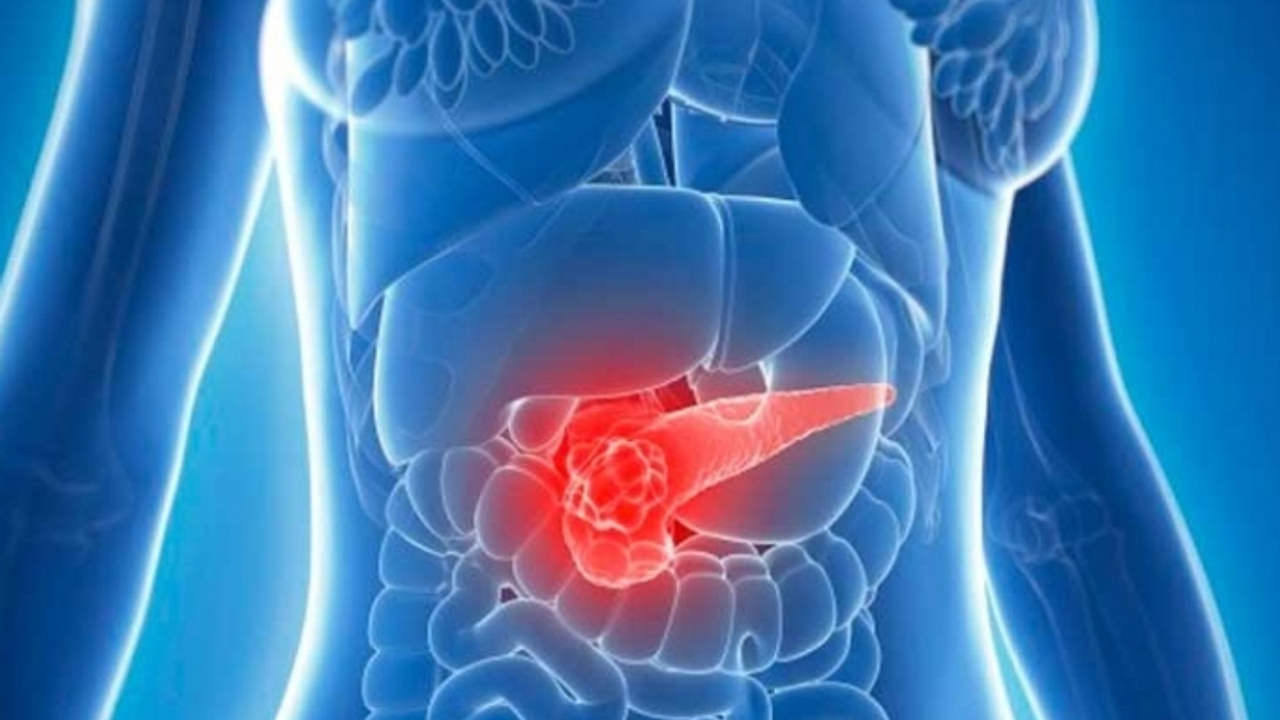 Diagnoosi – Haimasyöpä: Haimasyövän varoitusmerkit, jotka sinun tulisi tuntea