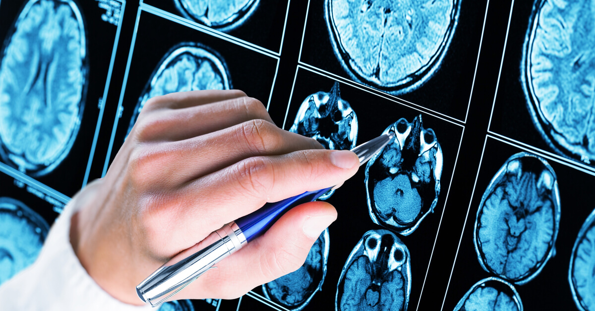 60 vuotta myöhemmin havaittu yllättävä vaikutus diabeteksen lääkkeestä aivoihin