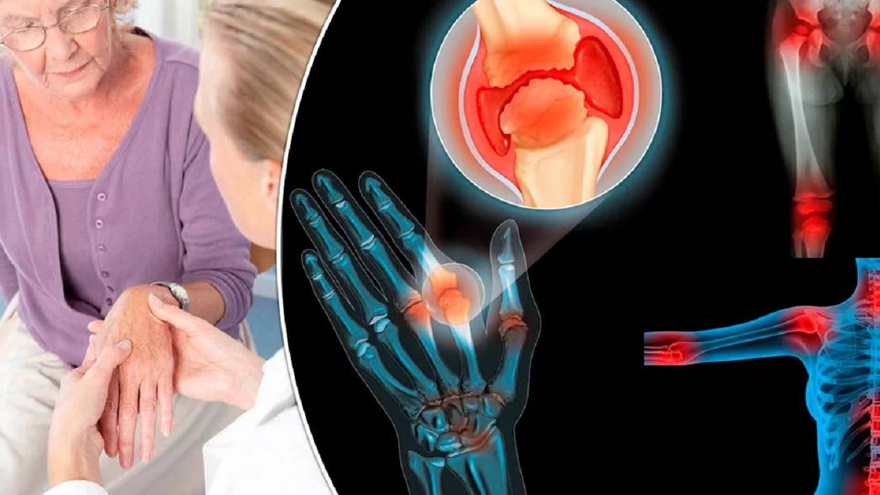 He selvittivät, miksi rustokudos tuhoutuu nivelrikossa ja miten se voidaan palauttaa.