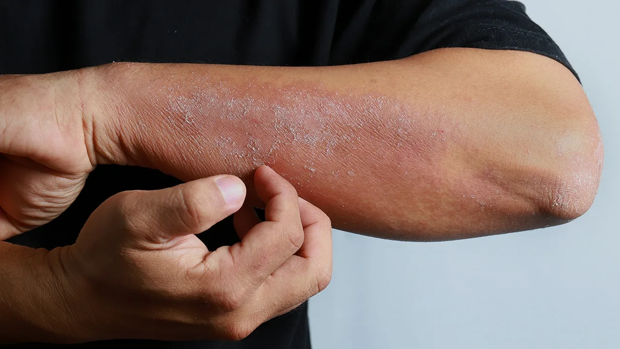 Heikkojen munuaisten oireet näkyvät iholla