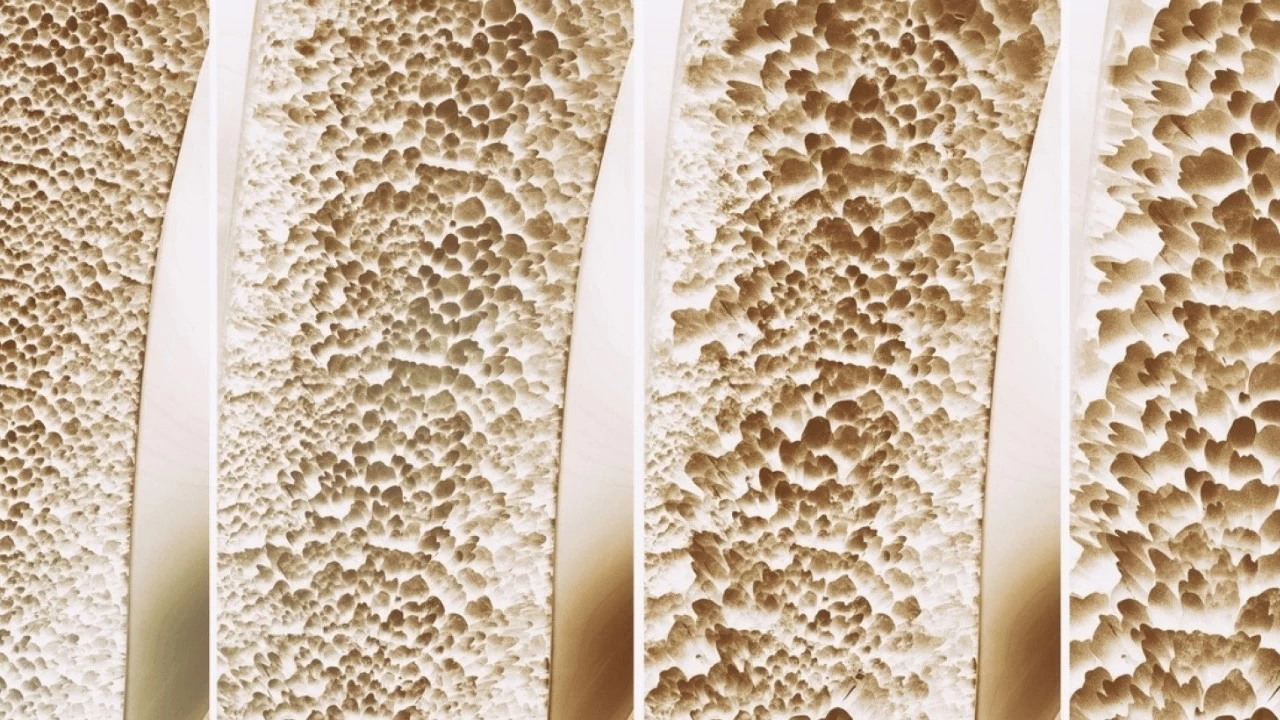 Uusi läpimurto luiden vahvistamisessa voi kääntää osteoporoosin suunnan