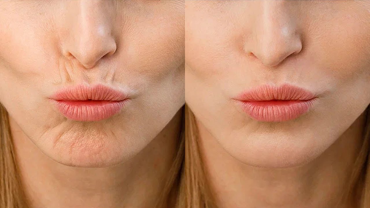 Kuinka pehmentää marionettirypyt ja vähentää ilmejuonteita luonnollisella tavalla