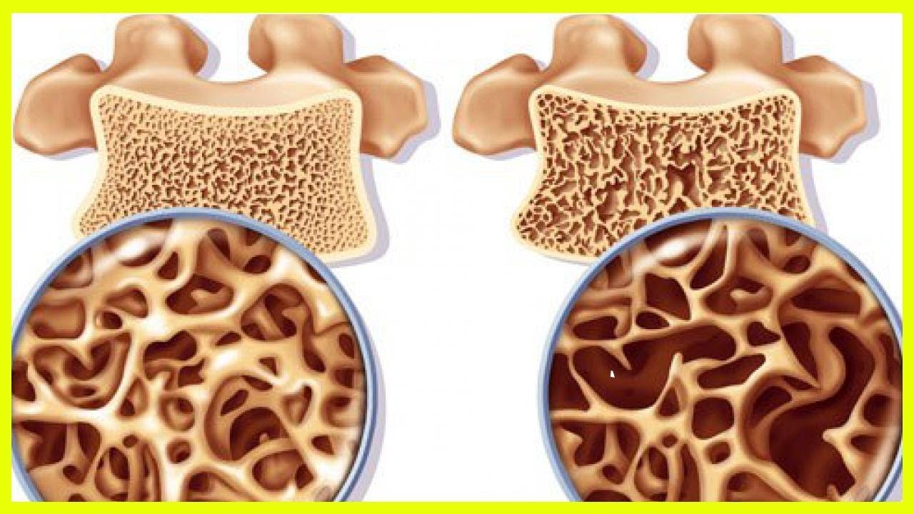 Uusi läpimurto luiden vahvistamisessa voi kääntää osteoporoosin suunnan