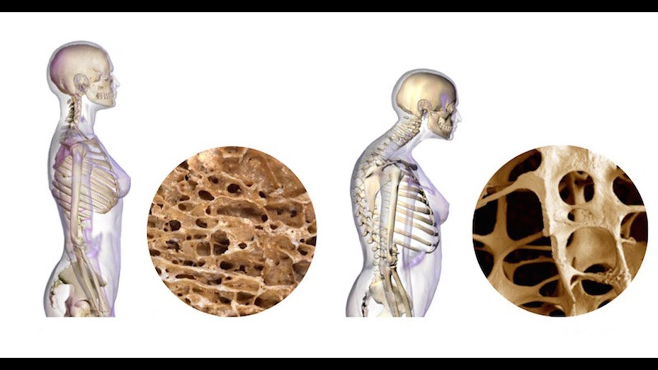 Uusi läpimurto luiden vahvistamisessa voi kääntää osteoporoosin suunnan